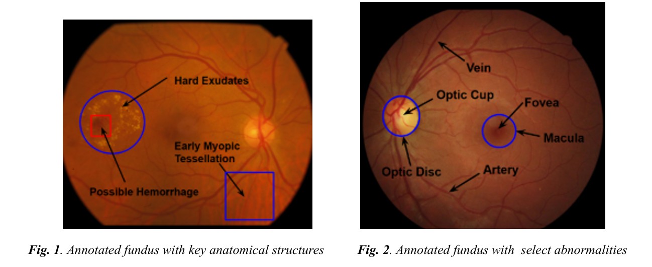 InSight AI Mobile Screening Tool for Multiple Eye Disease Detection using Multimodal Fusion